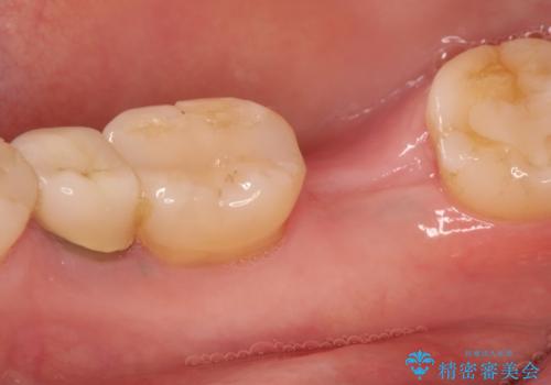 右下の奥歯を抜歯　インプラント治療による咬合回復の治療中
