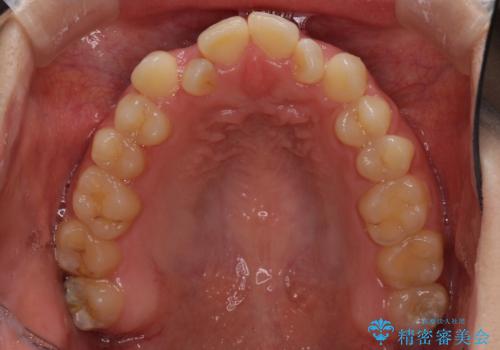 外科矯正は受けたくない 上顎骨拡大による妥協的な受け口治療の治療前