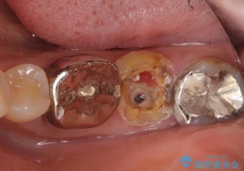 インプラントは嫌 親知らずの移植 50代女性の治療前