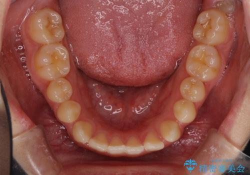 外科矯正は受けたくない 上顎骨拡大による妥協的な受け口治療の治療前