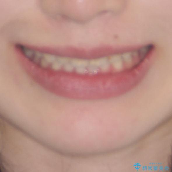 気になる前歯を美しく　マウスピース矯正とセラミッククラウンの治療後（顔貌）