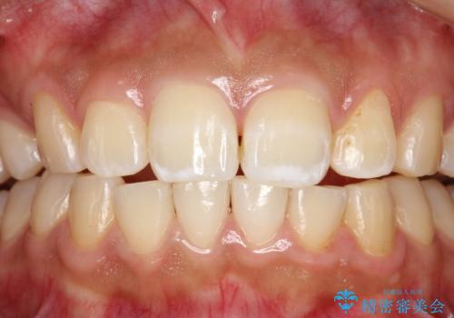 歯科医院で初めてのクリーニング PMTC30分コースの治療後