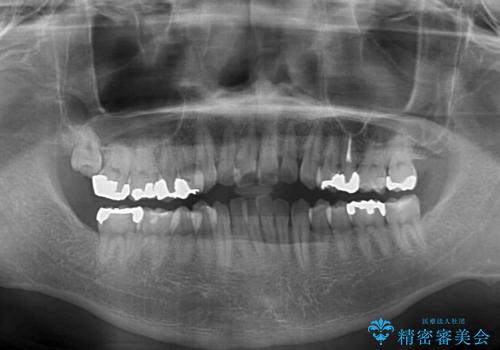 前歯のクロスバイトをインビザラインで矯正治療の治療前