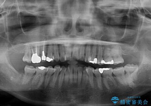切端咬合をインビザライン矯正で解消の治療前