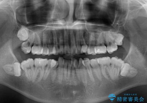 前歯の叢生を解消　ワイヤー装置での抜歯矯正の治療前