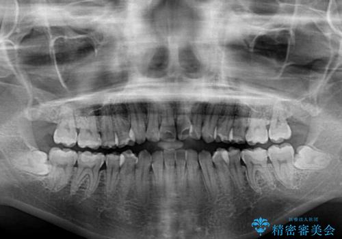 【モニター】オープンバイトをインビザラインで矯正治療の治療前