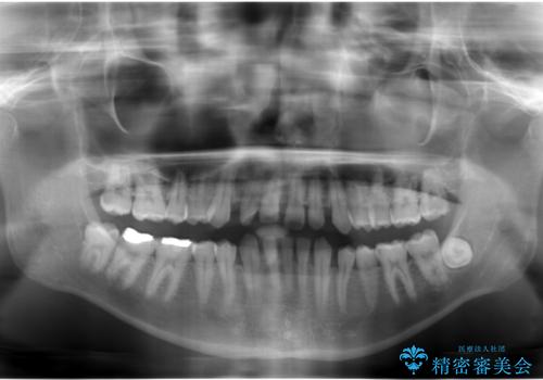 すきっ歯・出っ歯 コンプレックスの前歯を治したい 目立たない方法で セラミック治療は不可能な症例の治療前
