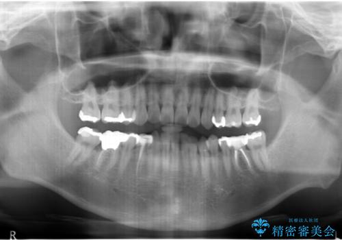 虫歯がひどく抜歯 奥歯をブリッジにの治療前