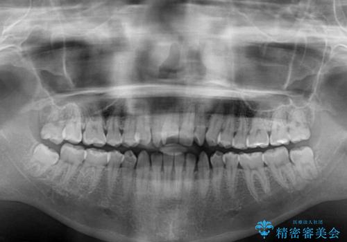 外科矯正は受けたくない 上顎骨拡大による妥協的な受け口治療の治療前