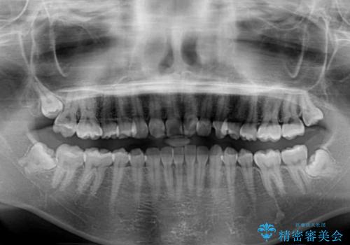 気になる前歯を美しく マウスピース矯正とセラミッククラウンの治療前