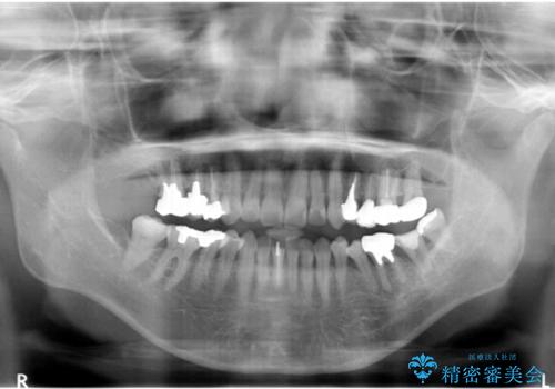 インプラントは嫌 親知らずの移植 50代女性の治療中