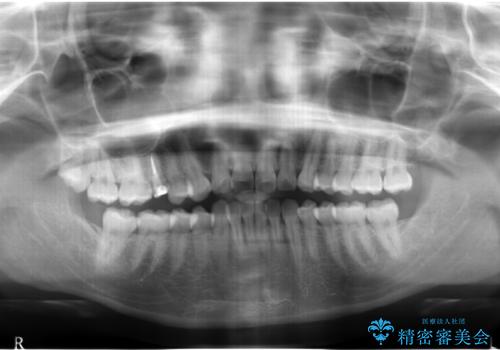 歯の高さがなく、しょっちゅう外れる 他院で治療途中だが病院を変えたいの治療前