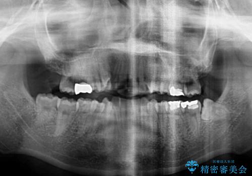 上下の八重歯を治したい　補助装置を用いたインビザライン矯正の治療前