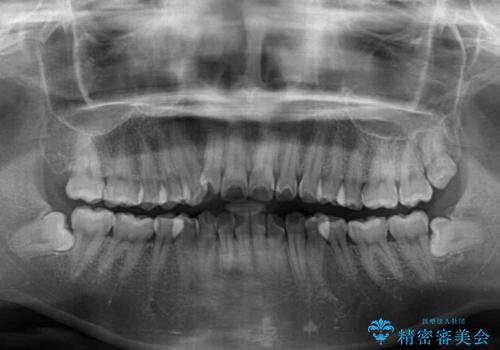 前歯のデコボコが気になる インビザラインによる矯正治療の治療前