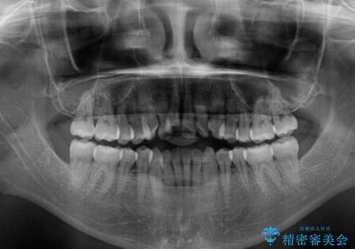 気になるデコボコとオープンバイト インビザラインでの矯正治療の治療前