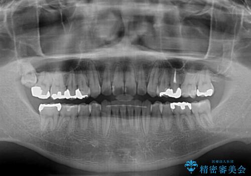 前歯のクロスバイトをインビザラインで矯正治療の治療後
