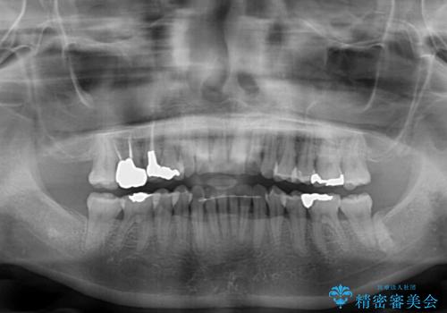 切端咬合をインビザライン矯正で解消の治療後