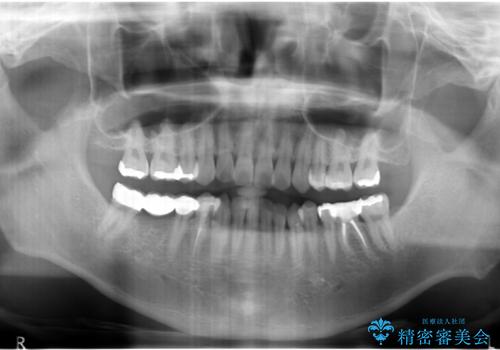 虫歯がひどく抜歯 奥歯をブリッジにの治療後