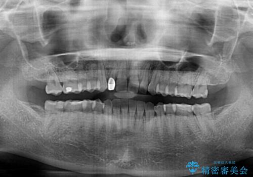前歯の歯並びと小さい歯を改善 インビザラインとオールセラミッククラウンの治療後