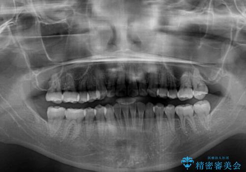 気になるデコボコとオープンバイト インビザラインでの矯正治療の治療後