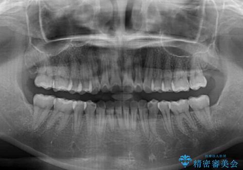 前歯のデコボコが気になる インビザラインによる矯正治療の治療後