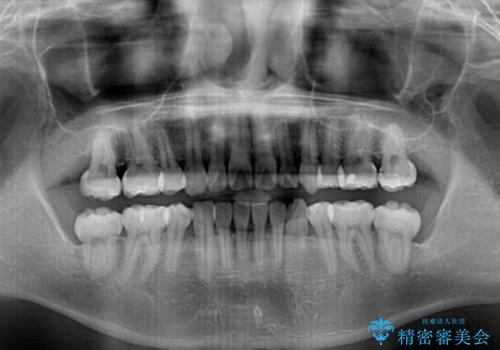 前歯の叢生を解消　ワイヤー装置での抜歯矯正の治療後