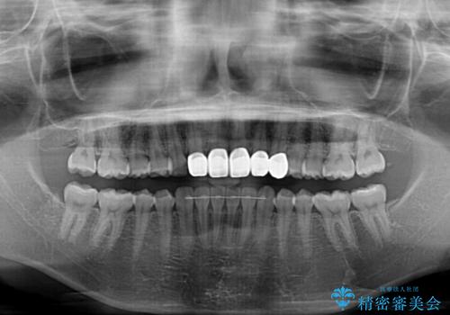 気になる前歯を美しく マウスピース矯正とセラミッククラウンの治療後