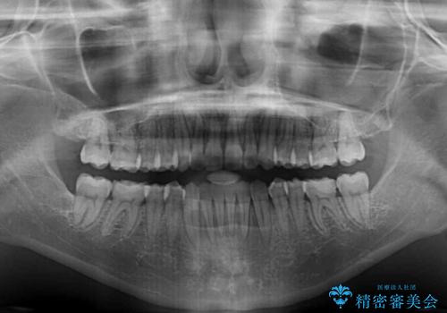 【モニター】オープンバイトをインビザラインで矯正治療の治療後