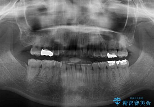 上下の八重歯を治したい 補助装置を用いたインビザライン矯正の治療後