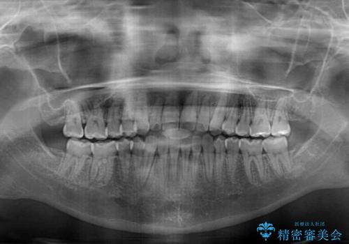 外科矯正は受けたくない　上顎骨拡大による妥協的な受け口治療の治療後