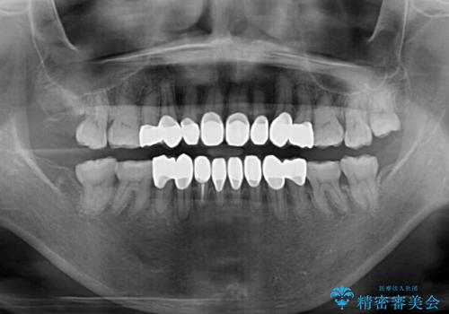 矯正の後戻りと変色歯を治したい　総合歯科診療の治療後