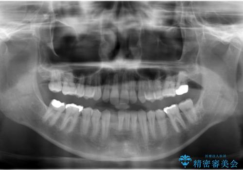 下の前歯のインプラント　生まれつき歯が少ないの治療前