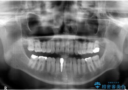 下の前歯のインプラント　生まれつき歯が少ないの治療後