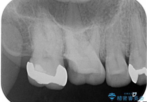 銀歯が外れてしまった ゴールドインレーによる補綴治療の治療前