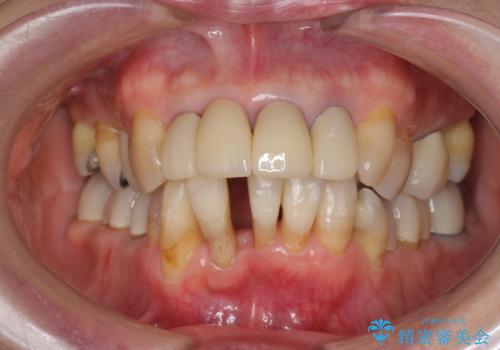 矯正を含む全顎治療の治療中