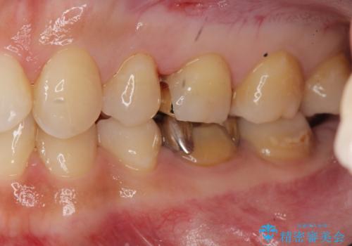笑った時に目立つ銀歯を白くしたいの治療前