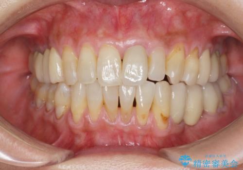 前歯の変色 セラミッククラウンによる審美回復の症例 治療後
