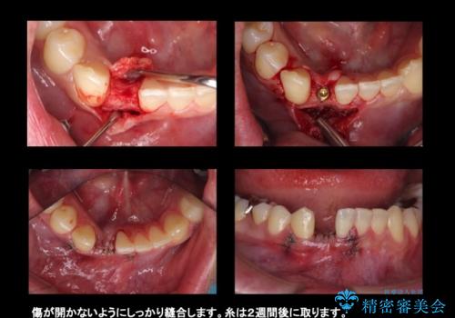 下の前歯のインプラント 生まれつき歯が少ないの治療中