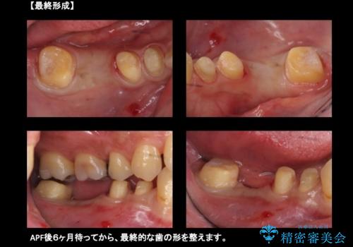 虫歯がひどく抜歯 奥歯をブリッジにの治療中