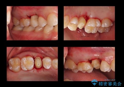 歯の高さがなく、しょっちゅう外れる 他院で治療途中だが病院を変えたいの治療中