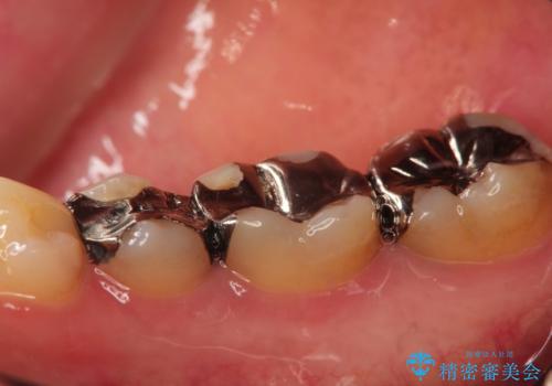 オールセラミッククラウン 神経が死んでいる歯の治療の治療前