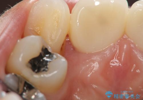 子供の頃にぶつけた前歯 根管治療から行うセラミック治療の治療中