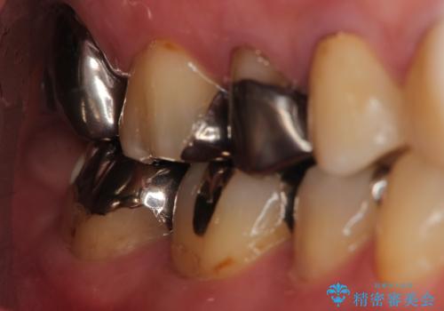 オールセラミッククラウン 神経が死んでいる歯の治療の治療前