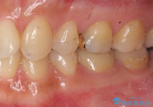 笑った時に目立つ銀歯を白くしたいの治療後