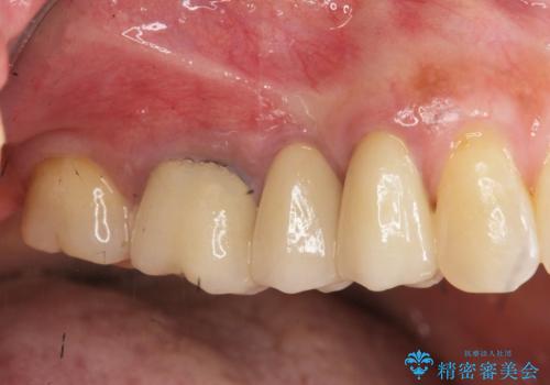 古くなったセラミッククラウンのやりかえの症例 治療後