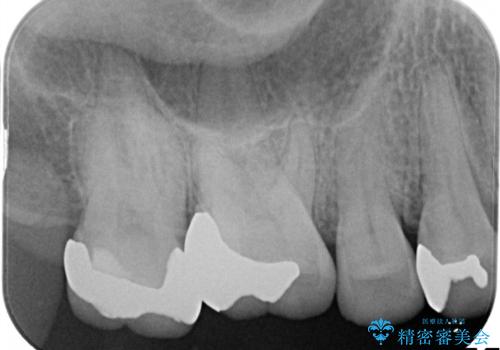 銀歯が外れてしまった ゴールドインレーによる補綴治療の治療後