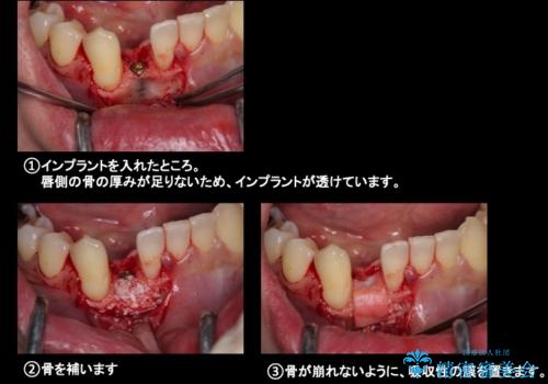 下の前歯のインプラント　生まれつき歯が少ないの治療中