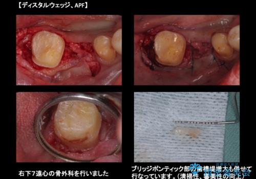 虫歯がひどく抜歯 奥歯をブリッジにの治療中