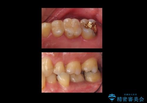 奥歯の詰め物のやりかえ　セラミックインレー、ゴールドインレーの治療後