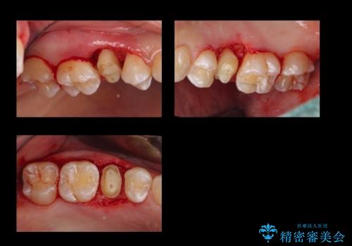 歯の高さがなく、しょっちゅう外れる 他院で治療途中だが病院を変えたいの治療中